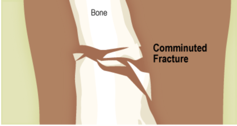 Comminuted Fractures