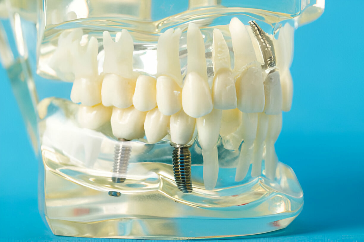 dental Implant Aberdeen