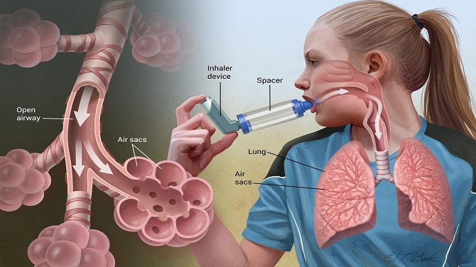 Homeopathic Treatment For Asthma