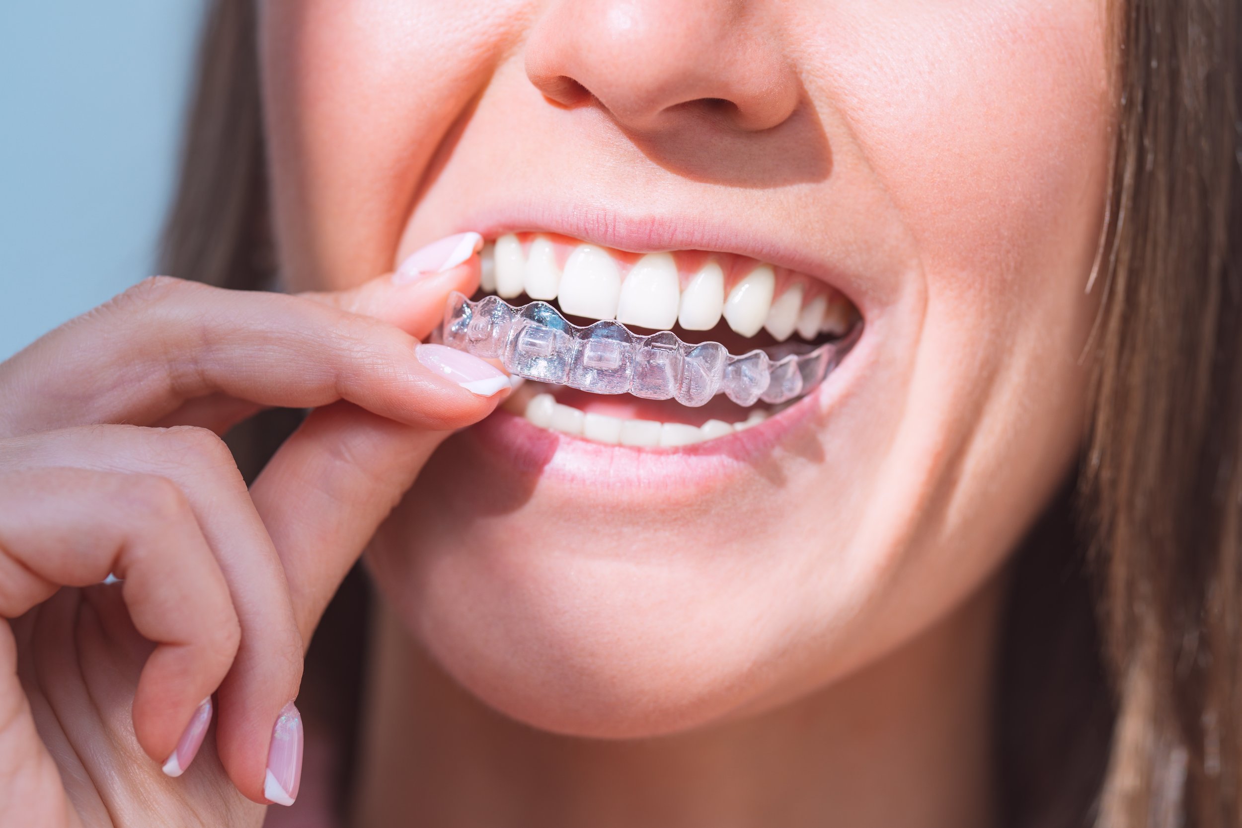 Invisalign Treatment in the UK