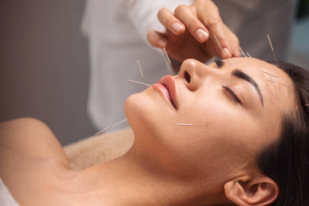 Acupuncture in Perth