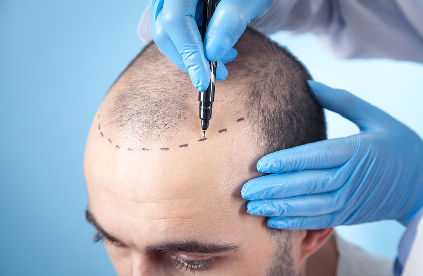 hair loss clinic manchester