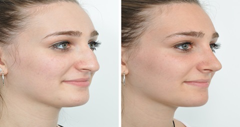 Understanding the Rhinoplasty Process: Insights from Dubai Surgeons