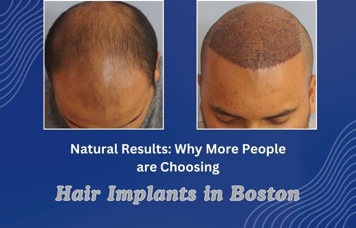 Natural-Results-Why-More-People-are-Choosing-Hair-Implants-in-Boston