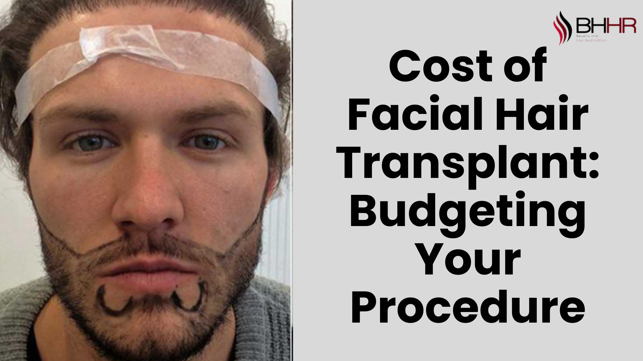 facial hair transplant cost