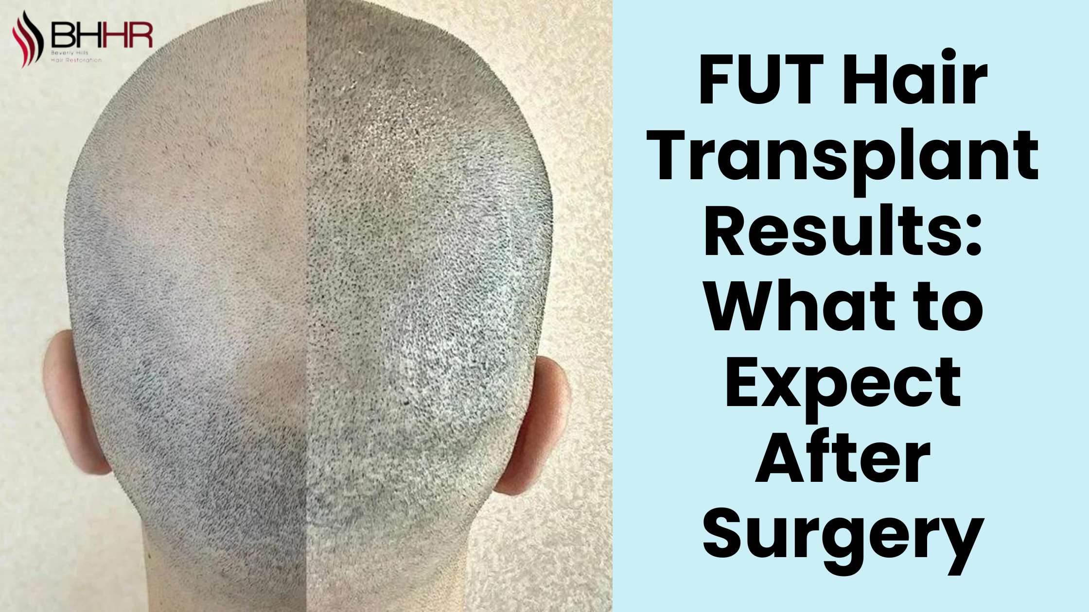 fut hair transplant results