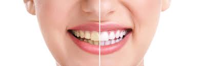 smile teeth whitening