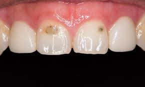 root canal on front tooth