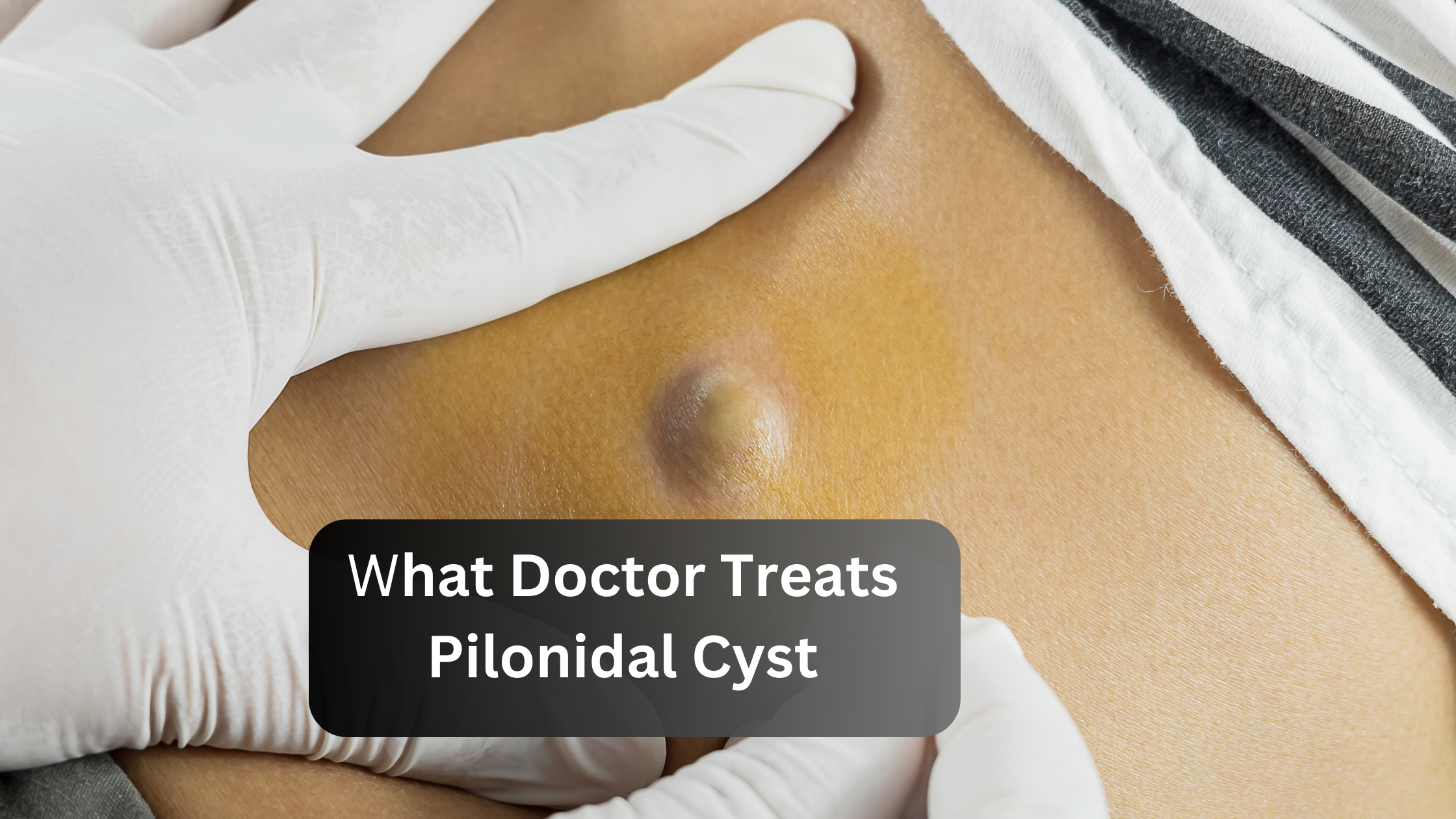 what doctor treats pilonidal cyst