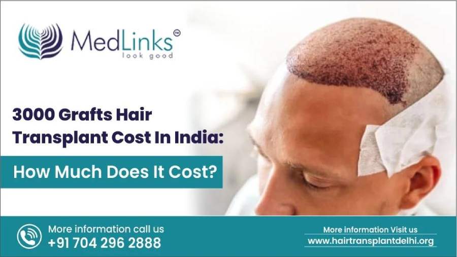 3000 Grafts Hair Transplant Cost In India