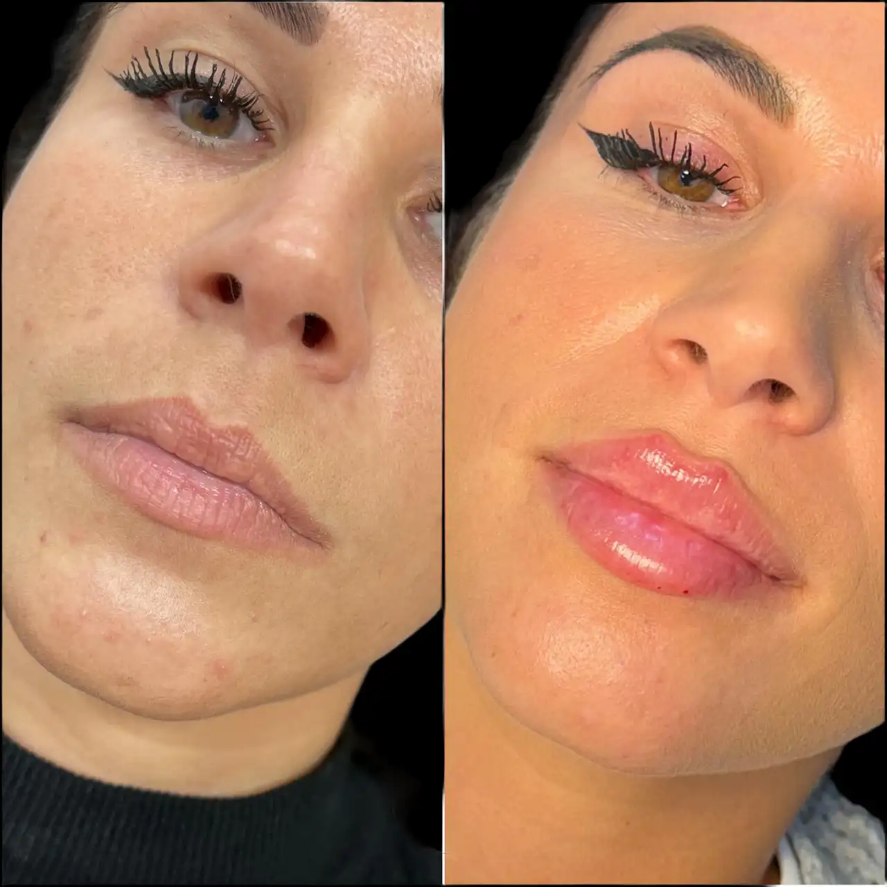 Juvederm Fillers