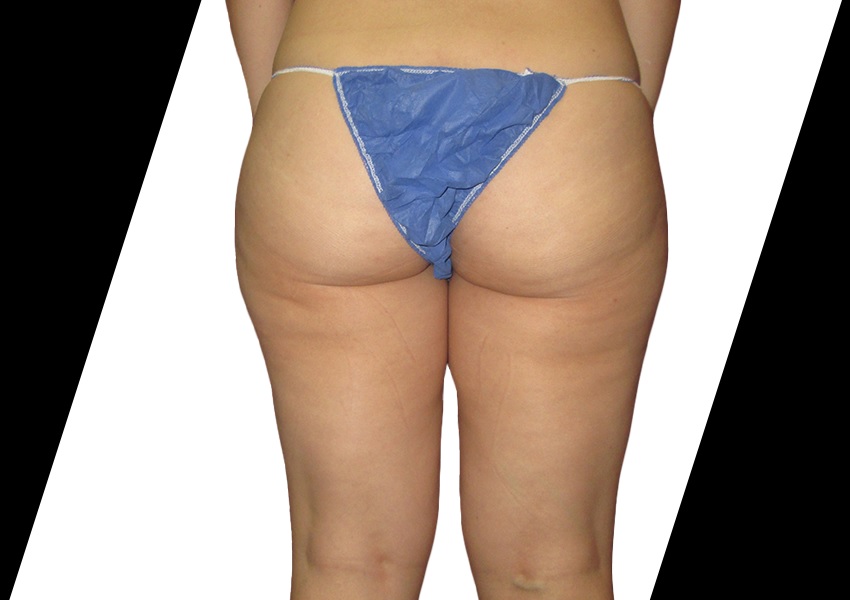 Liposuction Houston