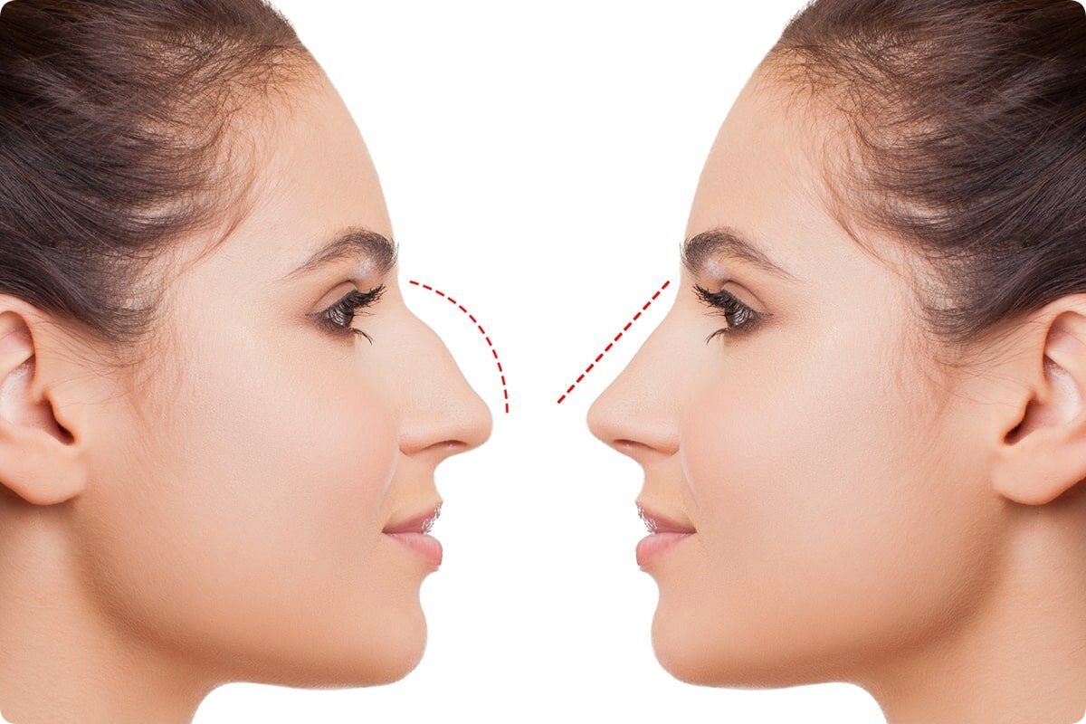 Rhinoplasty in Dubai (تجميل الأنف في دبي)