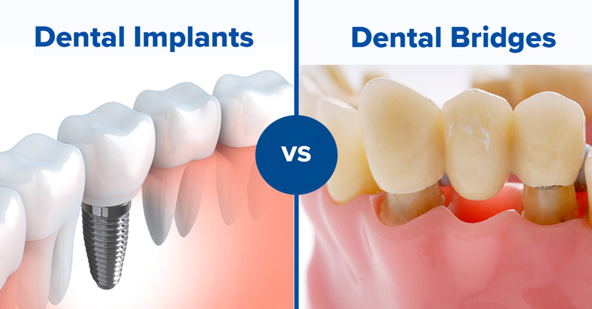 dental implants vs dental bridges