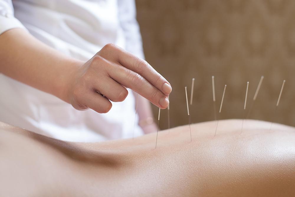 acupuncture therapy experts in Calgary AB