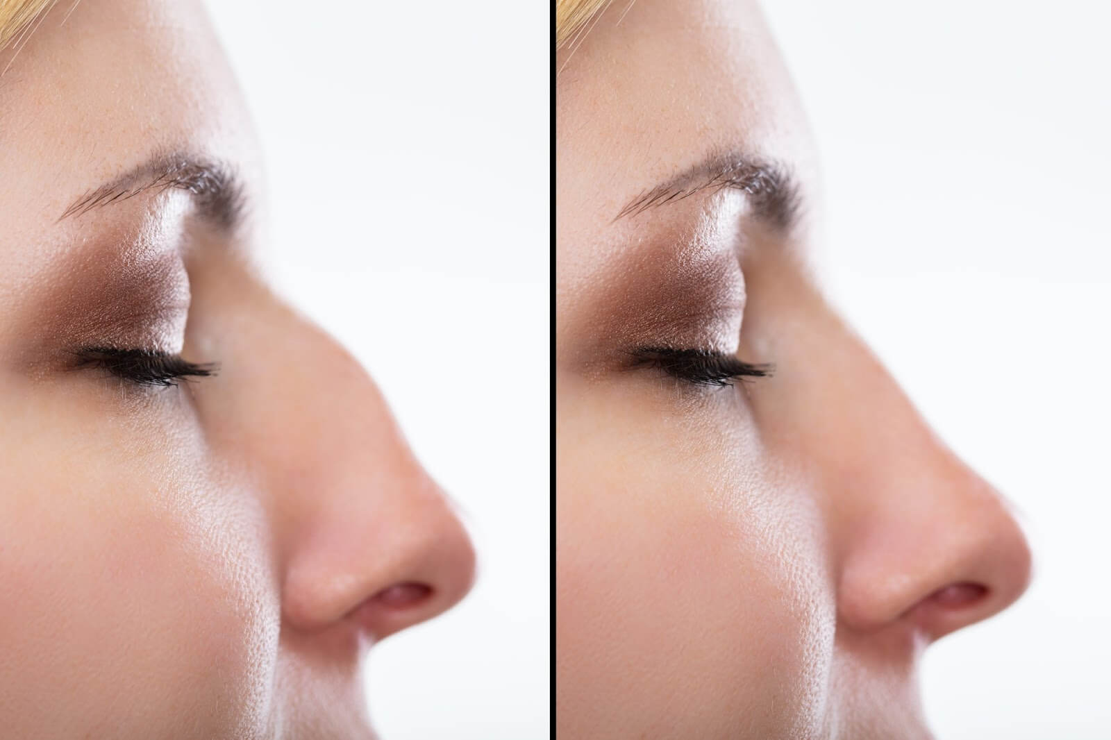 Rhinoplasty in Dubai (تجميل الأنف في دبي)