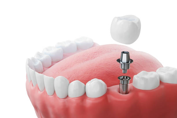 dental implants in Rochester